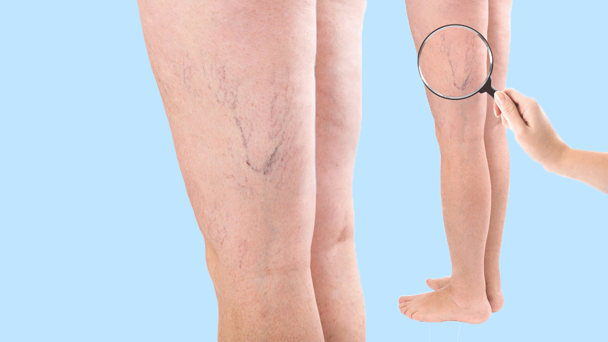 How to get rid of spider veins