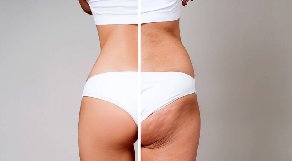 How VelaShape III body contouring works?