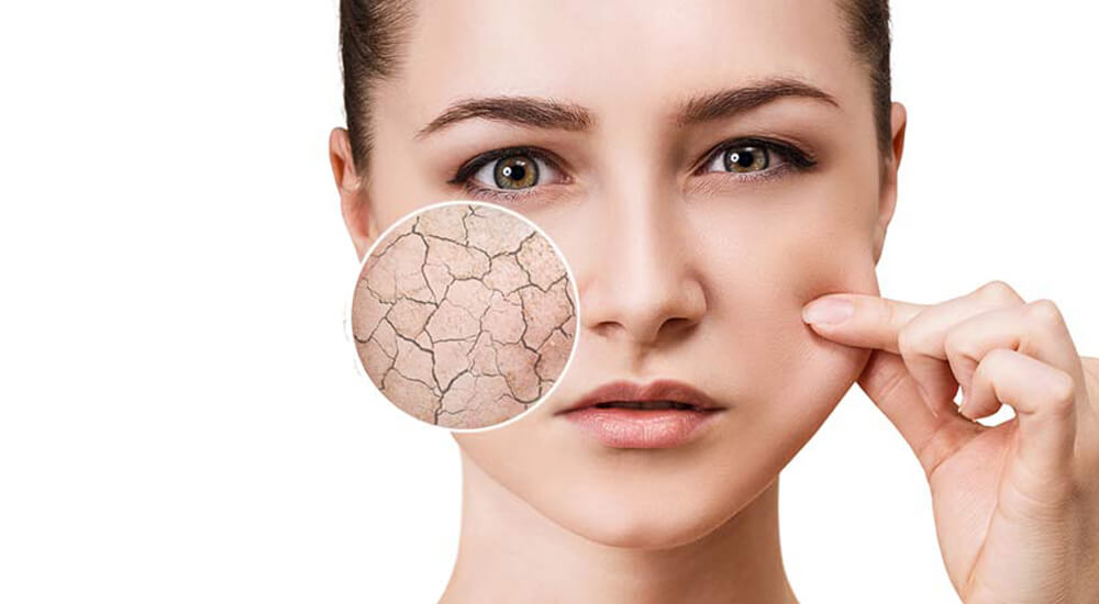 Dehydrated skin