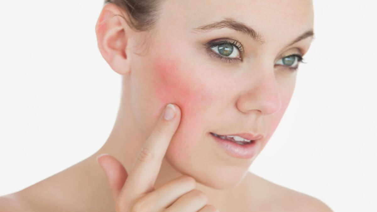 Rosacea skin condition