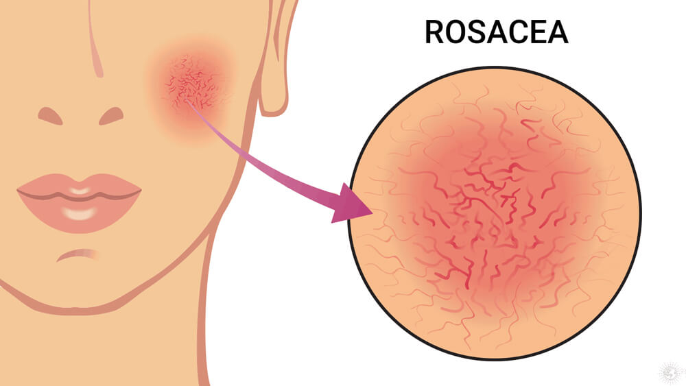 Rosacea skin redness