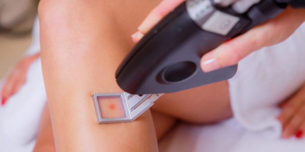 How much does laser hair removal last