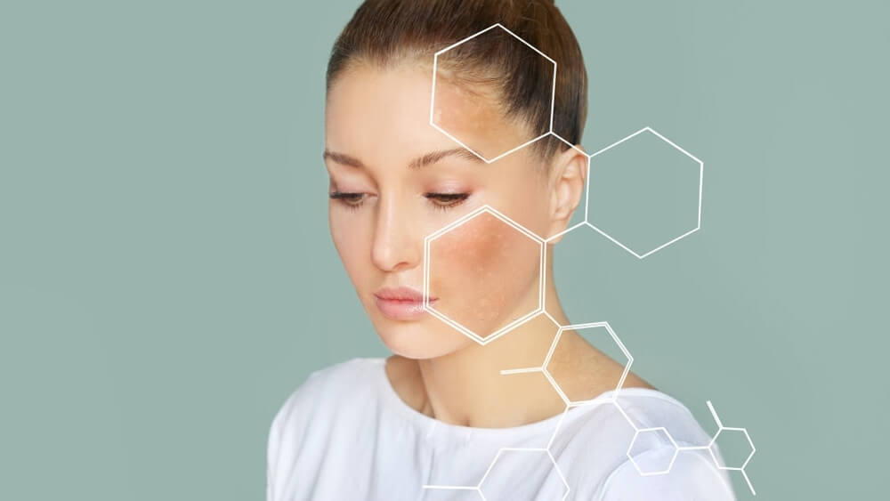 Dark spots freckles hyperpigmentation after laser therapy