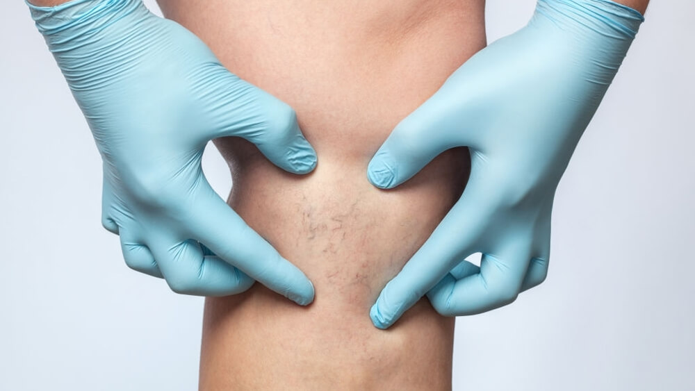 Doctor shows the dilation of spider veins