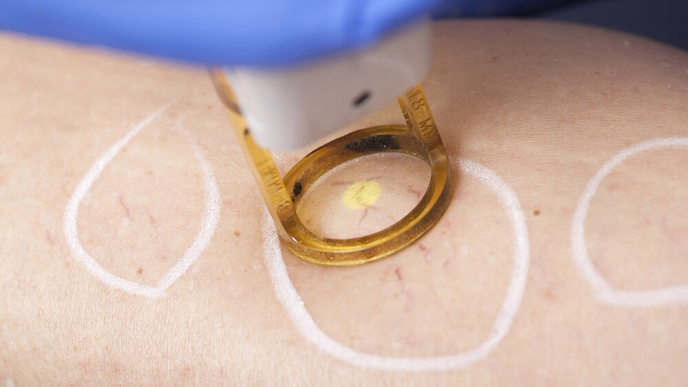 Spider vein medical laser treatment
