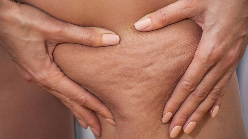 Can you get rid of cellulite