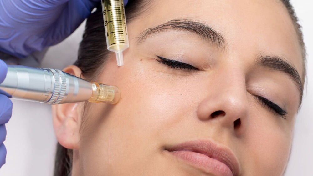 Woman having Microneedling treatment