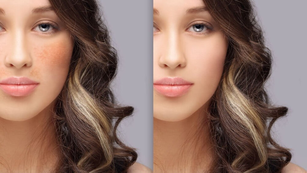 Before and after dark spots freckles hyperpigmentation
