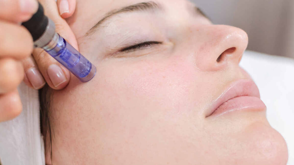 Microneedling treatment