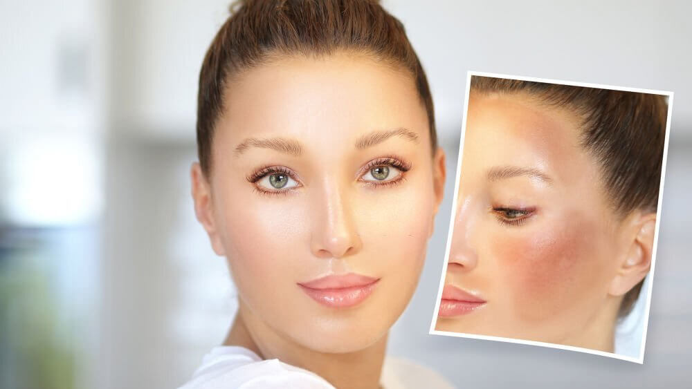 Before and after hyperpigmentation treatment