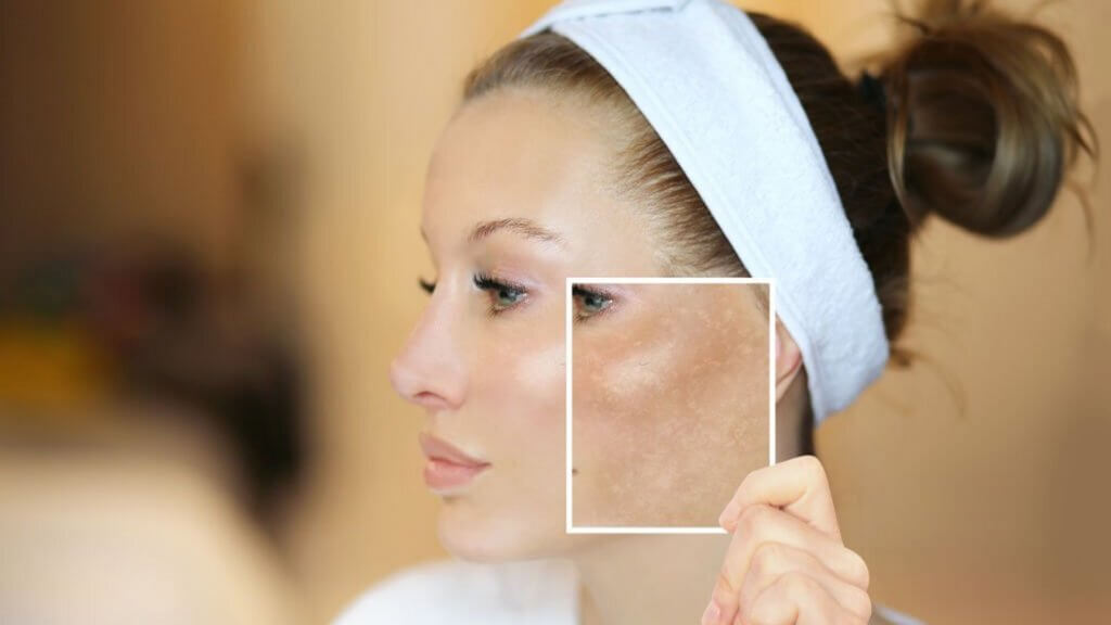 Dark spots freckles hyperpigmentation