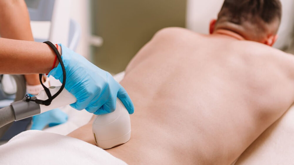 Man getting IPL body hair removal procedure at waist