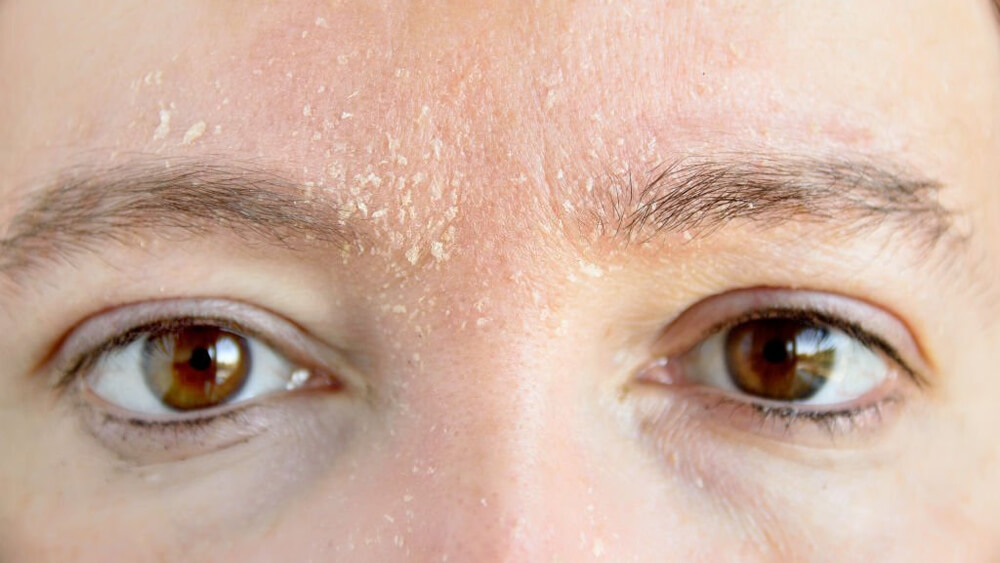Woman with atopic dermatitis