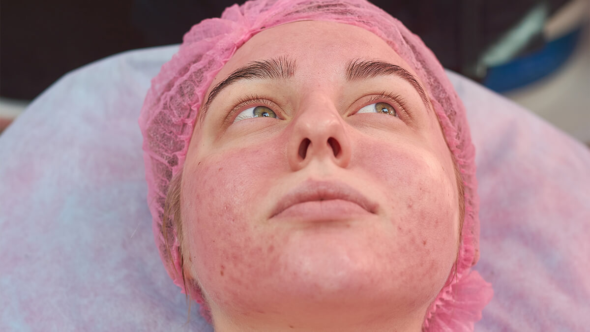 Face of young woman with acne