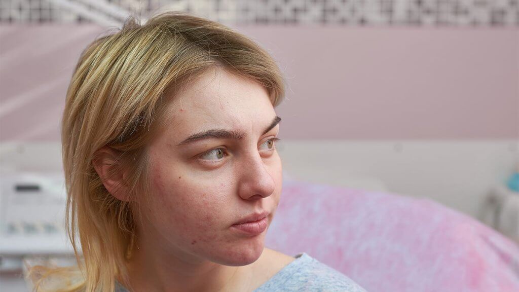 Woman with acne on her face looking sad