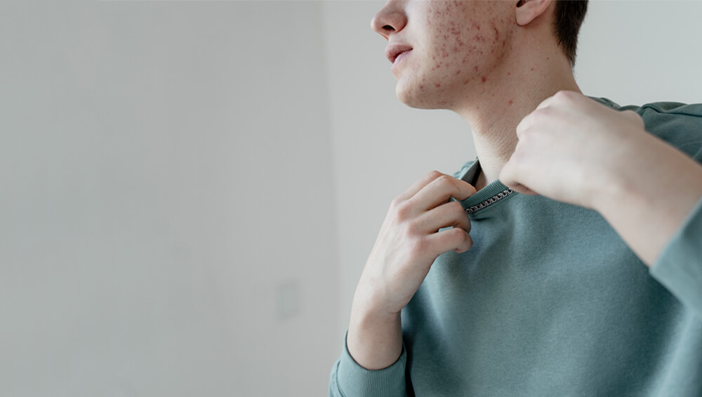 A man with acne on his face