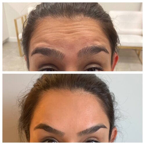 botox b & a