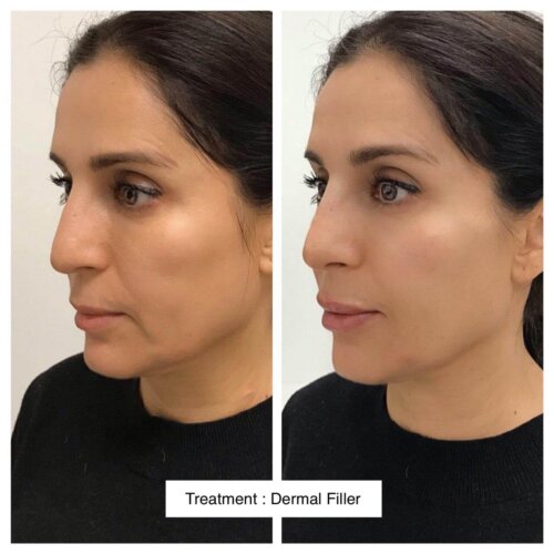 CELEBRITY DERMAL FILLER B AND F 1