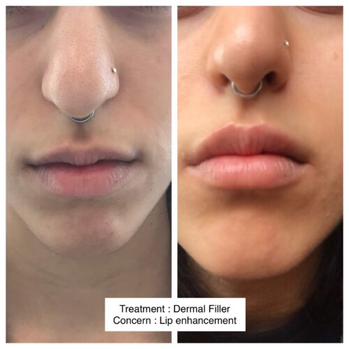 CELEBRITY DERMAL FILLER B AND F 2