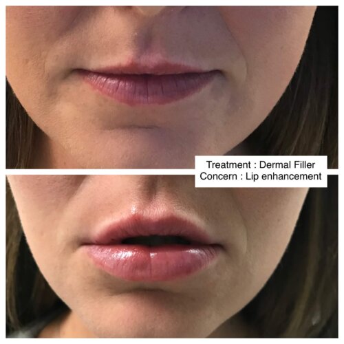 CELEBRITY DERMAL FILLER B AND F 3